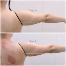 (유)신진 | 인천부평다이어트 리유뷰티에서 팔뚝살 승모근 관리 후기