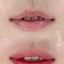 [ 강릉 입술문신 • 강릉 입술반영구 • 강릉오버립 탈각 후] And2bin 앤투빈 오버립 시술 (+ 후기 사진)