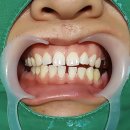 트리베일러(Baylor)치과의원 | 용인치아미백 잘한다고 소문난 곳, 트리베일러치과 솔직한 후기