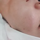 봉곡동395 | 구미 리프팅 봉곡동 피부관리샵 부티난다 하이푸리프팅 1500샷 후기