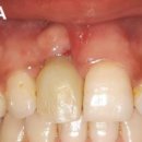 현대방사선기계 | 대구 임플란트주위염 치료 , 골든 타임을 놓치면 끝입니다
