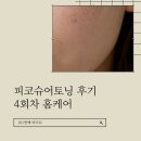 서현역피부과 분당피코토닝 :: 기미 홈케어 관리 후기