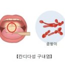 칸디다성 구내염 (Candidal Stomatitis) 이미지