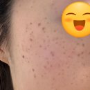 마법의원 | 루나의원 루비레이저 잡티제거 경과 내돈내산 후기(시술당일~2주)