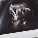 지에스25 서울대병원점 | [사산후 재임신] 분당서울대병원 전원 이후 막달 진료 후기 및 진료비