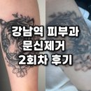 논현바른약국 | [강남역피부과 타투제거]피코슈어 팔 문신제거 2회차 후기