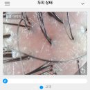 한올두피탈모