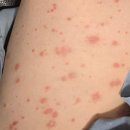 연제한의원 | 부산건선치료 한의원에서 받으면 효과 있을까? <논문자료 첨부>