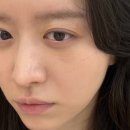 오가멍 | 대전 리쥬란힐러 4cc 손주사 내돈내산 후기 | 첫날부터 2주 후까지 멍/붓기/효과