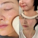 엑셀고급 | 엑셀웨이브 리프팅 튠라이너 온다 차이 선릉역 피부과 얼굴윤곽개선 후기