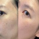 미래한의원 | 합리적인 가격의 부산 편평사마귀 한의원 후기. 이곳이 바로 무제한 제거 성지?!