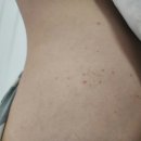 세부 여행 중 갑작스런 몸살, 발열, 뎅기열 의심으로 UCM 병원 진료 후기