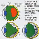 비문증이란? 이미지