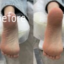 정우프라자 | 천안 불당동 무좀 내성발톱 관리 전문점 레푸스, 발각질 제거 후기