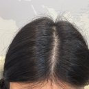 세븐일레븐 의정부센트럴타워점 | 의정부두피관리 웰킨 두피 탈모센터 | 혼자서는 절대 안떼지는 비듬 두피 관리 후기