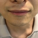 아빠광고 | [내돈내산] 촉촉이 아빠의 부산 남자 레이저제모 솔직후기(광고X)