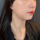 올타이트리프팅 400샷만에 턱선 하프한 효과 본 신사 피부클리닉 의원 후기