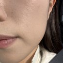 디자인300 | 과천피부과 원장님 1:1 상담 꼼꼼한 디자인 세르프 300샷 가격 통증 일주일 변화 후기