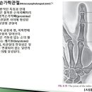 [9강-15 ](54강) 뉴만운동학 8장(Hand)(2),MCP관절,곁인대(끈,덧부분),뼈/관절운동형상학, PIP/DIP관절 이미지