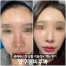 진선미피부 | 압구정 피부과 쥬베룩스킨 케뉼라로 앞볼맞은 효과 후기