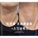 [강남성형외과 쥬베룩 후기] 목주름 쥬베룩볼륨 + 스킨보톡스 전후 비교 후기