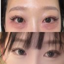 화이트라인하얀피부과의원 | 강남역피부과에서 아이리쥬란 1CC 맞고 왔어요 내돈내산 솔직후기💉