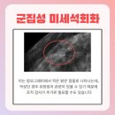 천안 아산 미유외과 맘모톰 수술 후기 | 확대촬영으로 유방석회화 발견 후 제거까지