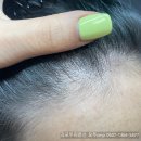 50 | 김포헤어라인문신 후기 (50대여자)