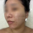 (주)디에프브이투 | 수원시청역피부관리 온다리프팅 이중턱 브이라인 더마인뷰티 내돈내산 솔직후기