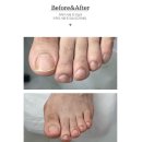 인천 계산동 발톱무좀 관리 레푸스 계양구청점