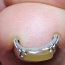 메디인 | 내성발톱 교정기 메디인랩 착용법 1년 6개월 실제 착용 자가치료 후기