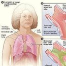기관지염 급성 기관지염 만성기관지염 차이점 기관지염 원인 증상 치료방법 이미지