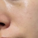 자연예쁨의원 | 건대입구피부과 필로드 예쁨주의쁨의원 건대점 비포에프터