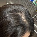 한신센타뷰 | 민감성 붉은두피, 얇아진모발, 여성형탈모예방 : 대구 라파드 두피탈모관리 모리케어생식 1회차 후기