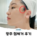 1cm | 광주 운암동 피부과 점제거, "1cm 크기 큰점" 광주 점제거 솔직후기