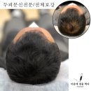 마음에점을찍다두피SMP 이미지