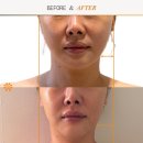 시그니처랩스 | 붓기·턱선·광대 고민이라면? 검단 윤곽관리 추천! 롱슬로 타임랩스 윤곽관리 후기