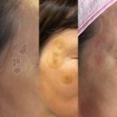 봄스피부과의원 | 흑자제거레이저 교대 봄스피부과 : 50대 흑자 기미잡티 제거 후기, 전후사진, 효과, 주의사항