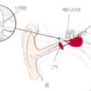 마스크를 너무 세게 조일 경우 일어나는 중이 압착과 폐쇄 이미지