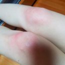 무릎 연골연화증, 난각막 영양제 후기 관절건강전문브랜드 백세포뮬러 내돈내산