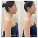 월곡역/동덕여대 피부관리샵 &#39;타라테라피&#39; 상체관리 전,후 즉각 변화사진 (라쎄 오프닝오일)