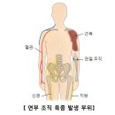 연부조직 육종[Soft tissue sarcoma] 근골격질환, 종양혈액질환 이미지