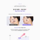 마리오네트 주름 수술 진행 방식