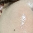 이리산소 | 강남역피부과 추천 다운타임 없는 내돈내산 수분관리 후기