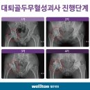 대퇴골두무혈성괴사//대퇴골두무혈성괴사 수술 잘하는곳 이미지