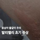 메디칼밸리 | 여행 물갈이 발리밸리 두드러기 경험담 (초기증상, 예방, 상비약 체크리스트)