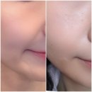 하남미사 피부과 추천 쥬베룩후기