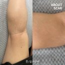 안양벤처텔 앞 | 종아리 튼살 오래된 흰줄 자국 커버타투 후기, 안양 튼살커버 추천