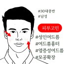 판교 여드름 피부과 상담 후기, 30대 남성 염증성 여드름으로 고생하신 분