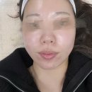 강동-천호-2438 | 강동역 기미잡티제거, 클리어스팟으로 화장 잘먹는 피부 탄생 미작뷰티 강동점